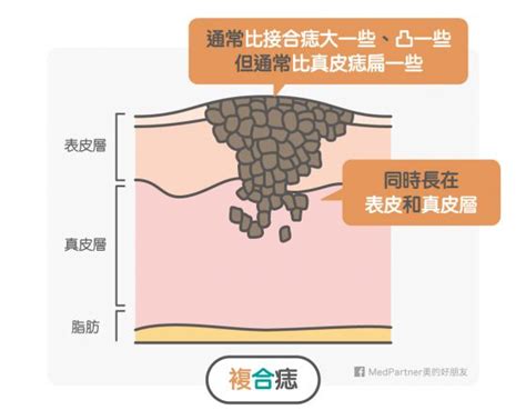 痣長在臉上|美人痣、三八痣、觀音痣，痣怎麼來的又該如何消去？。